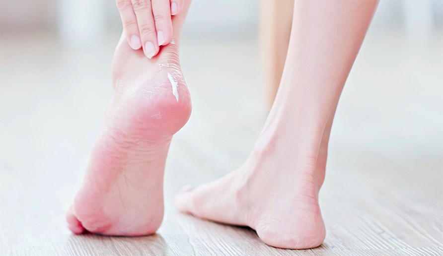 Hand som smrjer in torra ftter med fotkrm.